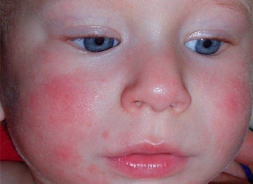 Сыпь на коже у ребенка – причины и способы лечения