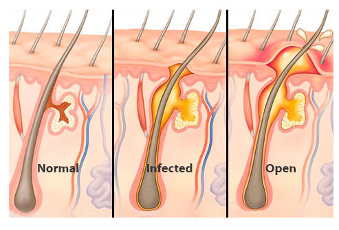 Как Выглядят Фурункулы Фото