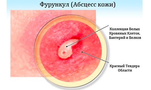 Вскрытие и дренирование фурункула в области наружных половых органов