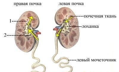 Пиелонефрит хронический